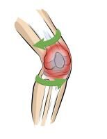 Vorschau: Vital Comfort Kniebandage PatellaTec für Sport u. Regeneration, perfekter halt durch Silikonstreifen