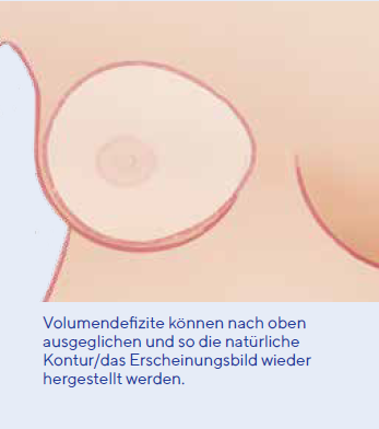 THUASNE SILIMA OVAL SHELL Teil- und Ausgleichsepithese Haut Cup B beidseitig verwendbar