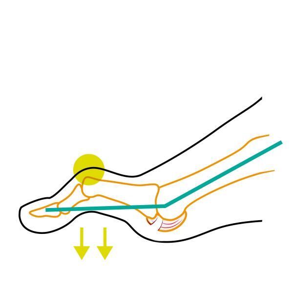 COMPRESSANA TAPE SOX Korrektur/Hilfe bei Hammerzehe wirkt einer Versteifung entgegen